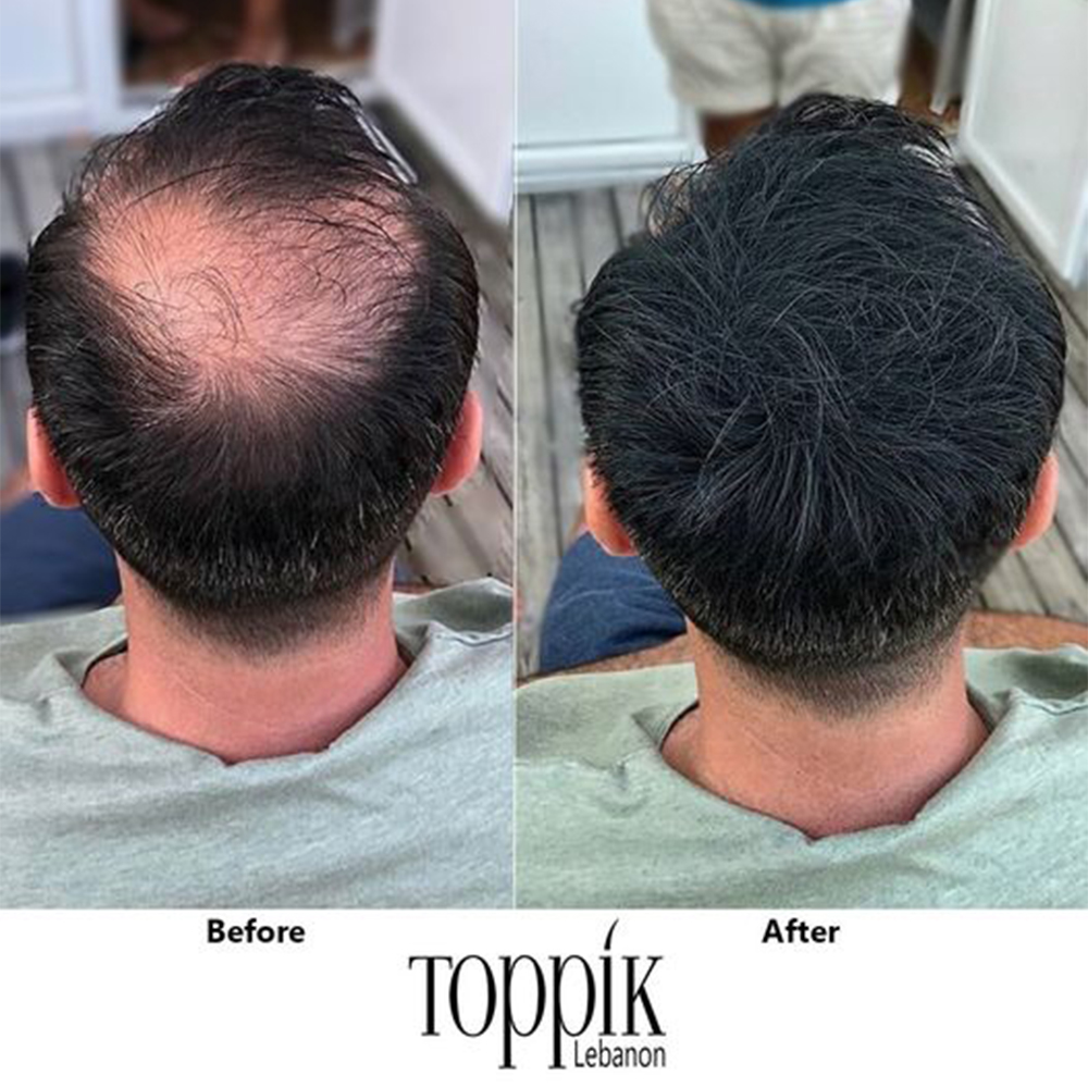 مجموعة العناية بالشعر (Toppik Hair Fibers لفراغات الشعر+Enliven لتثبيت الشعر ) مجموعة العناية بالشعر (Toppik Hair Fibers لفراغات الشعر+Enliven لتثبيت الشعر ) العناية الشخصية مجموعة العناية بالشعر (Toppik Hair Fibers لفراغات الشعر+Enliven لتثبيت الشعر ) مجموعة العناية بالشعر (Toppik Hair Fibers لفراغات الشعر+Enliven لتثبيت الشعر ) العناية الشخصية